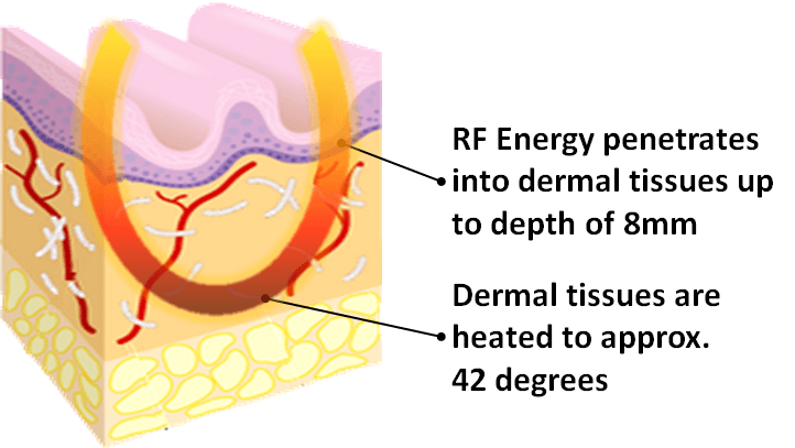 RF skin tightening during
